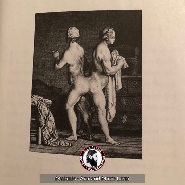 Conjoined twins - historical engraving