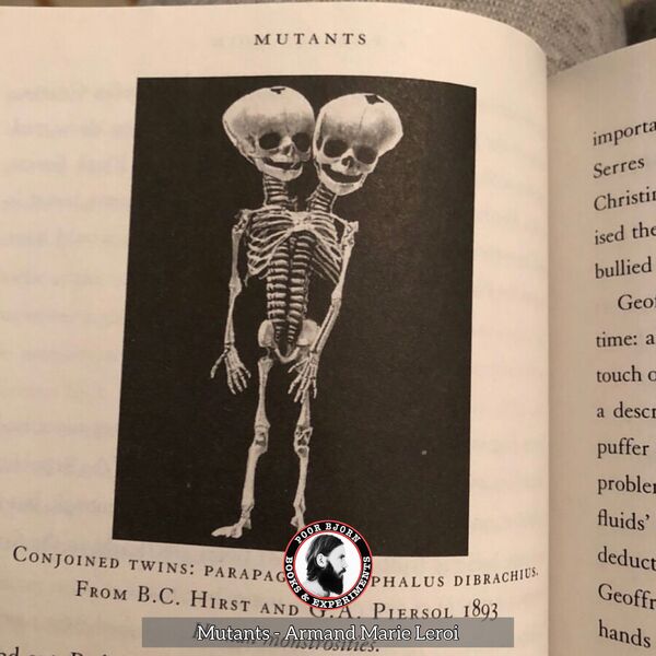 Conjoined twins - parapagus dicephalus dibrachius