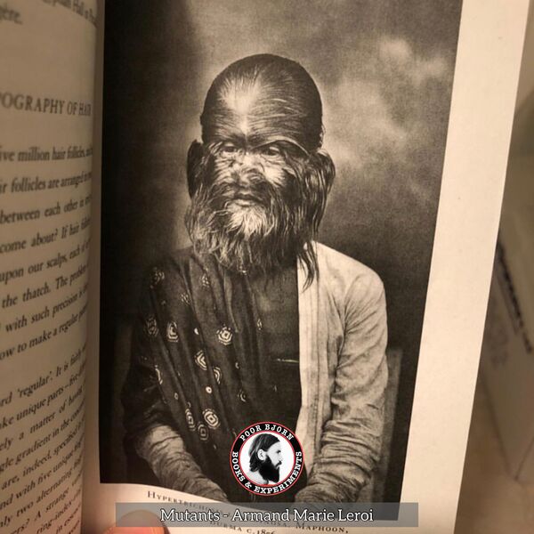Hypertrichosis - Shwe-Maong, Burma c.1856
